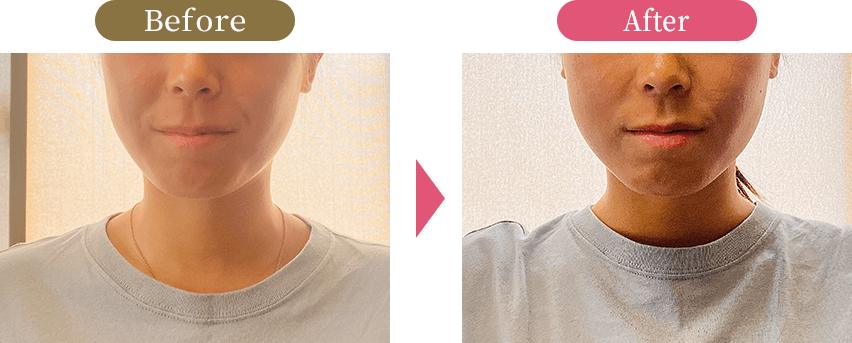 大阪市旭区で40代女性のフェイスラインのたるみを改善する小顔矯正施術の様子 美活ボディサロンめいてる
