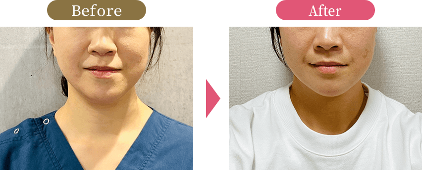大阪市旭区で40代女性のフェイスラインのたるみを改善する小顔矯正施術の様子 美活ボディサロンめいてる