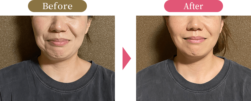 大阪市旭区で40代女性のフェイスラインのたるみを改善する小顔矯正施術の様子 美活ボディサロンめいてる