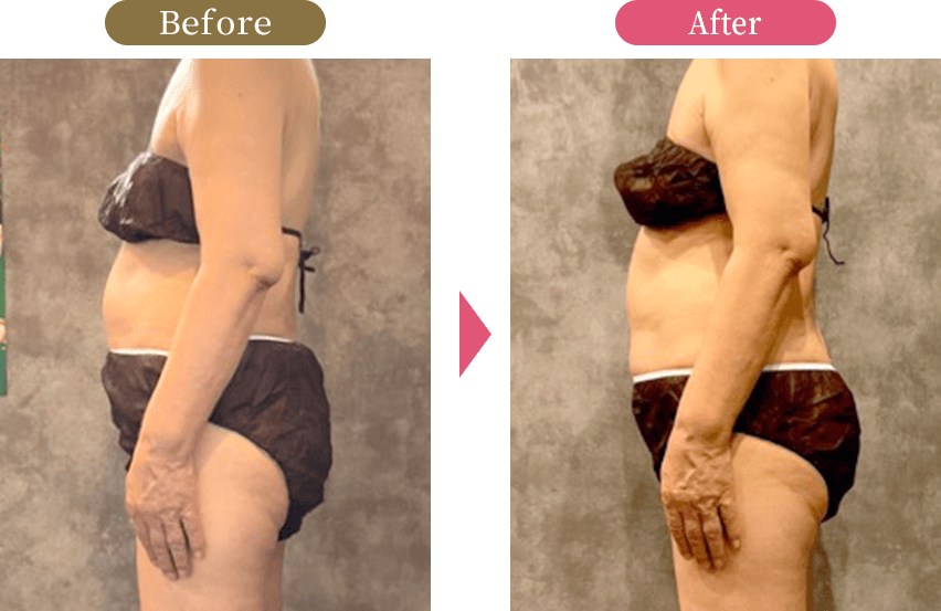 大阪市旭区の痩身ラジオ波施術後のボディラインの変化を示す写真