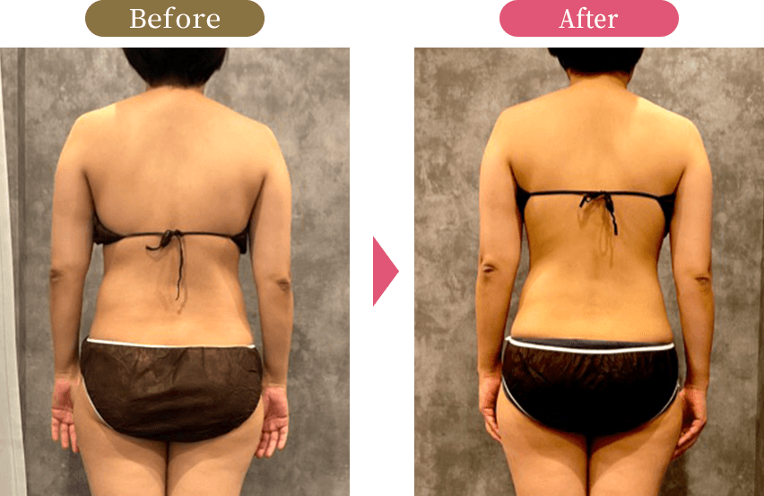 大阪市旭区の痩身ラジオ波施術後のボディラインの変化を示す写真