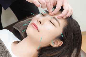 大阪市旭区で40〜50代女性のくすみ・たるみ改善に対応する美容鍼施術の様子 美活ボディサロンめいてる