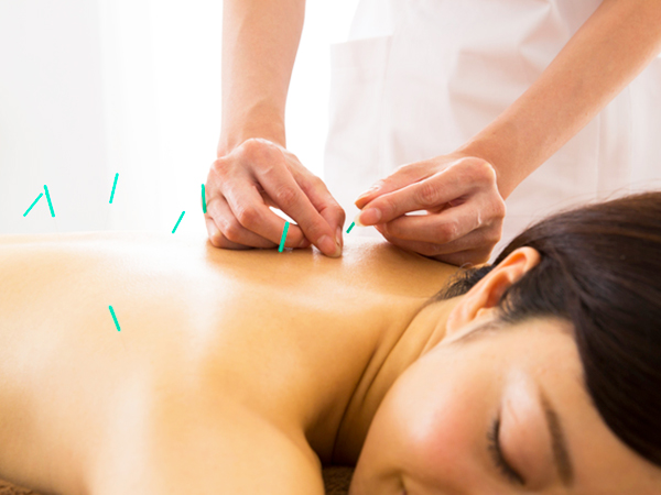 美容鍼（全身）