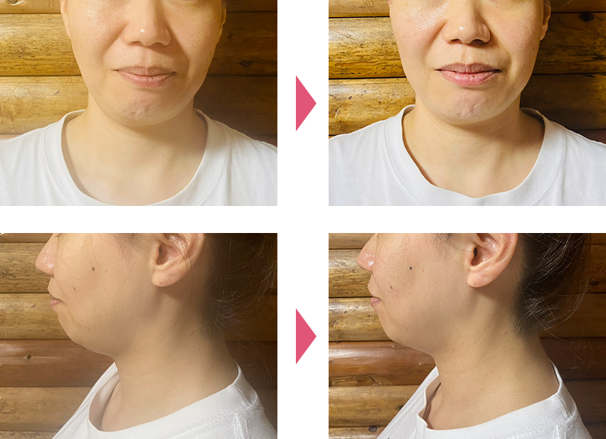 美容鍼ビフォアアフター