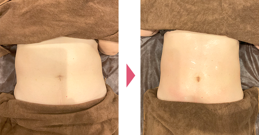 部分痩せビフォアアフター