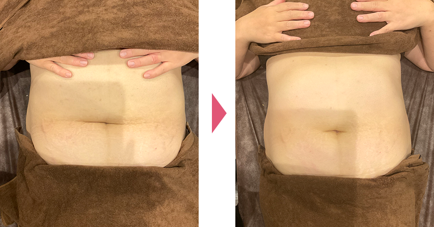 部分痩せビフォアアフター