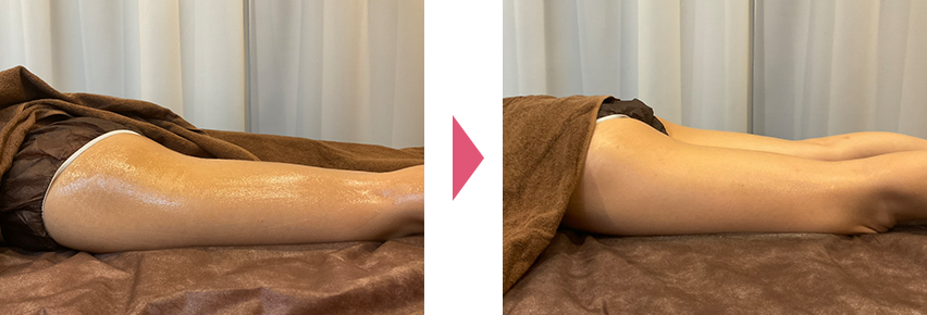 部分痩せビフォアアフター