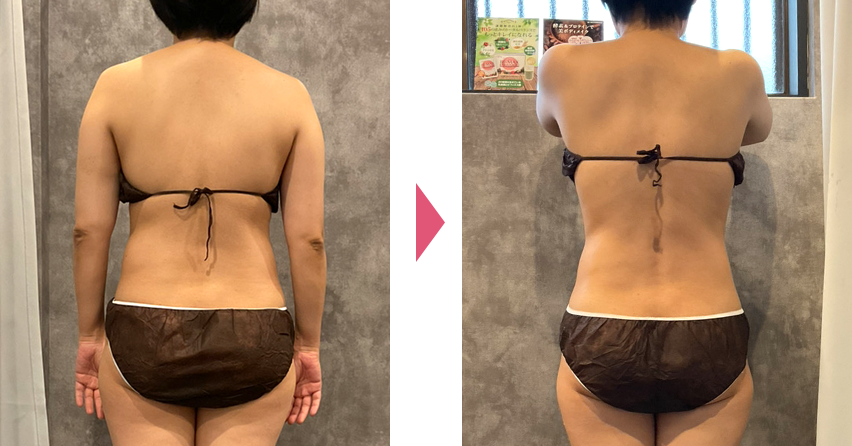 部分痩せビフォアアフター