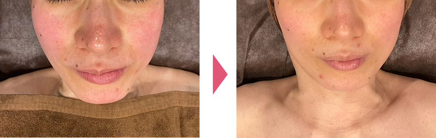 フェイシャルビフォアアフター